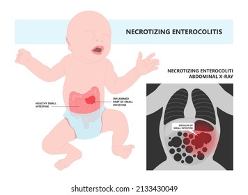 Ileus Bowel Toxic Small Midgut Cecal Colon Tract Hirschsprung's Gastric Ladd Band Large Hiatal Hernia Cancer Tumor Swollen Crohn's X-ray Meckel's Twist Blocked Birth Defect Infant Children Pain Short