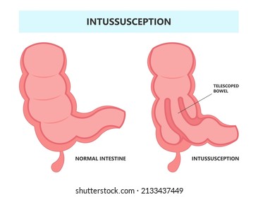 Ileus Bowel Toxic Small Midgut Cecal Colon Tract Hirschsprung's Gastric Ladd Band Large Hiatal Hernia Cancer Tumor Swollen Crohn's X-ray Meckel's Twist Blocked Birth Defect Infant Children Pain Short