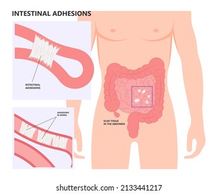 Ileus Bowel Toxic Small Midgut Cecal Colon Tract Hirschsprung's Gastric Ladd Band Large Hiatal Hernia Cancer Tumor Swollen Crohn's X-ray Meckel's Twist Blocked Birth Defect Infant Children Pain Short