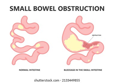 Ileus Bowel Toxic Small Midgut Cecal Colon Tract Hirschsprung's Gastric Ladd Band Large Hiatal Hernia Cancer Tumor Swollen Crohn's X-ray Meckel's Twist Blocked Birth Defect Infant Children Pain Short