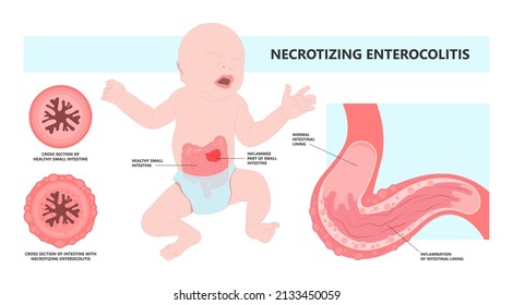 Ileus Bowel Toxic Small Midgut Cecal Colon Tract Hirschsprung's Gastric Ladd Band Large Hiatal Hernia Cancer Tumor Swollen Crohn's X-ray Meckel's Twist Blocked Birth Defect Infant Children Pain Short