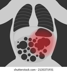 Ileus Bowel Toxic Small Midgut Cecal Colon Tract Hirschsprung's Gastric Ladd Band Large Hiatal Hernia Cancer Tumor Swollen Crohn's X-ray Meckel's Twist Blocked Birth Defect Infant Children Pain Short