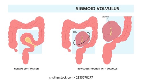 Ileus Bowel Toxic Small Midgut Cecal Colon Tract Hirschsprung's Gastric Ladd Band Large Hiatal Hernia Cancer Tumor Swollen Crohn's X-ray Meckel's Twist Blocked Birth Defect Infant Children Pain Short