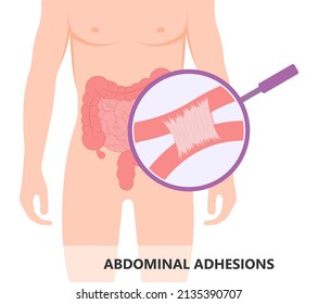 Ileus Bowel Toxic Small Midgut Cecal Colon Tract Hirschsprung's Gastric Ladd Band Large Hiatal Hernia Cancer Tumor Swollen Crohn's X-ray Meckel's Twist Blocked Birth Defect Infant Children Pain Short