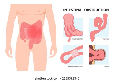 Ileus Bowel Toxic Small Midgut Cecal Colon Tract Hirschsprung's Gastric Ladd Band Large Hiatal Hernia Cancer Tumor Swollen Crohn's X-ray Meckel's Twist Blocked Birth Defect Infant Children Pain Short