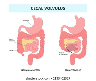 Ileus Bowel Toxic Small Midgut Cecal Colon Tract Hirschsprung's Gastric Ladd Band Large Hiatal Hernia Cancer Tumor Swollen Crohn's X-ray Meckel's Twist Blocked Birth Defect Infant Children Pain Short