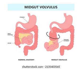 Ileus Bowel Toxic Small Midgut Cecal Colon Tract Hirschsprung's Gastric Ladd Band Large Hiatal Hernia Cancer Tumor Swollen Crohn's X-ray Meckel's Twist Blocked Birth Defect Infant Children Pain Short