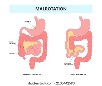 Ileus Bowel Toxic Small Midgut Cecal Colon Tract Hirschsprung's Gastric Ladd Band Large Hiatal Hernia Cancer Tumor Swollen Crohn's X-ray Meckel's Twist Blocked Birth Defect Infant Children Pain Short