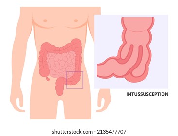 Ileus Bowel Toxic Small Midgut Cecal Colon Tract Hirschsprung's Gastric Ladd Band Large Hiatal Hernia Cancer Tumor Swollen Crohn's X-ray Meckel's Twist Blocked Birth Defect Infant Children Pain Short