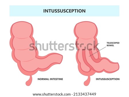 ileus bowel toxic small midgut cecal colon tract Hirschsprung's gastric Ladd band large hiatal hernia cancer tumor swollen crohn's x-ray meckel's twist blocked birth defect infant children pain short