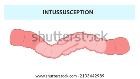 ileus bowel toxic small midgut cecal colon tract Hirschsprung's gastric Ladd band large hiatal hernia cancer tumor swollen crohn's x-ray meckel's twist blocked birth defect infant children pain short