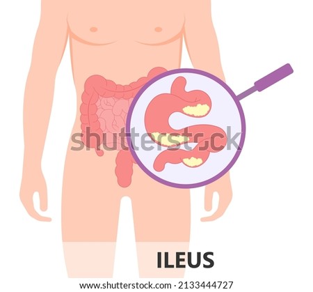 ileus bowel toxic small midgut cecal colon tract Hirschsprung's gastric Ladd band large hiatal hernia cancer tumor swollen crohn's x-ray meckel's twist blocked birth defect infant children pain short