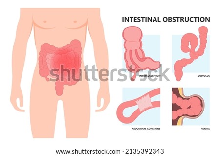 ileus bowel toxic small midgut cecal colon tract Hirschsprung's gastric Ladd band large hiatal hernia cancer tumor swollen crohn's x-ray meckel's twist blocked birth defect infant children pain short