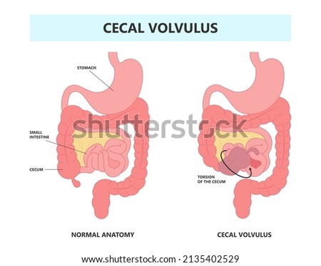 ileus bowel toxic small midgut cecal colon tract Hirschsprung's gastric Ladd band large hiatal hernia cancer tumor swollen crohn's x-ray meckel's twist blocked birth defect infant children pain short