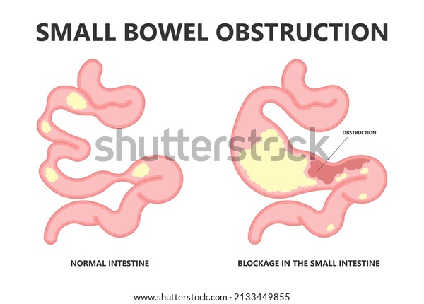 Ileus Bowel Toxic Small Midgut Cecal Stock Vector (Royalty Free ...