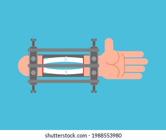 Ilizarov apparatus for arm. Compression-distraction apparatus. Bone splicing apparatus