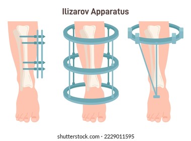 The Ilizarov apparatus set. External ring fixation technique in orthopedic surgery to lengthen or reshape limb bones. Flat vector illustration