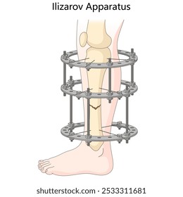 Aparelho de Ilizarov usado para alongamento ortopédico dos membros e alinhamento de fratura óssea, técnicas de fixação externa diagrama desenhado à mão ilustração vetorial. Ilustração educacional de ciências médicas