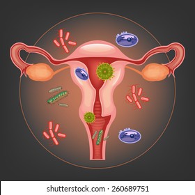 Ill female reproductive system. Vector illustration 