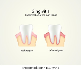 illustartion of gingivitis