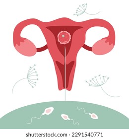 Ilustración con procedureinsemination Intrauterine, IUI. El embarazo planificador Ilustración con óvulos, célula espermática buena para la clínica de posters.