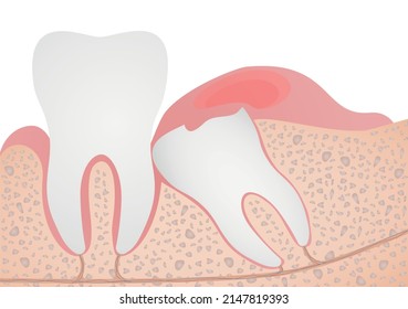  Illustrated anatomy of wisdom tooth eruption problems. Inflamed gums. Medical vector illustration.