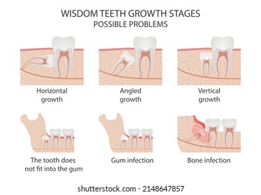 Anatomía ilustrada de problemas de erupción dental de sabiduría. Ilustración vectorial médica.