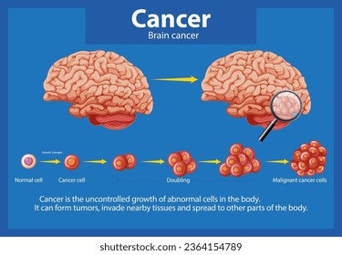 Illustrated guide to brain cancer and abnormal cell growth