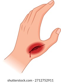 Mano humana ilustrada con un corte sangrante, mostrando laceración de la piel y detalles de lesiones médicas. Útil para arte médico, educación de primeros auxilios, imágenes de anatomía e ilustraciones de atención médica.