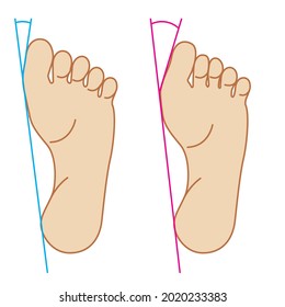 Illustrated illustration of hallux valgus. Represents bending or deformation of the toes.