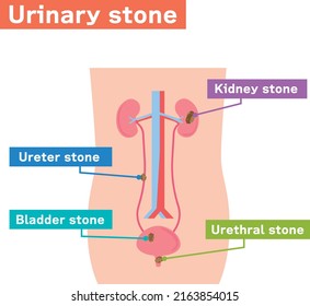 Ilustración ilustrada de piedras urinarias