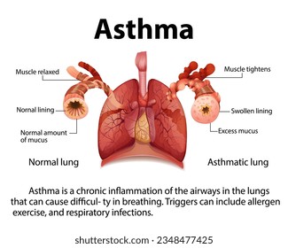 Illustrierte Infografik zum Vergleich der Anatomie der normalen und der Asthma-Lunge beim Menschen