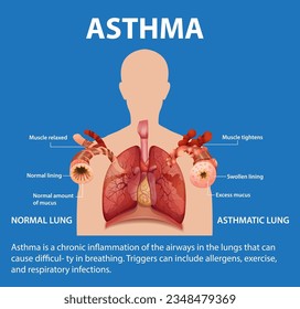 Illustrierte Infografik zum Vergleich menschlicher Lungen unter normalen und asthmatischen Bedingungen