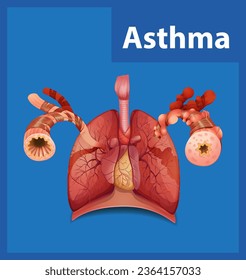Illustrated infographic comparing normal and asthma lungs in medical education