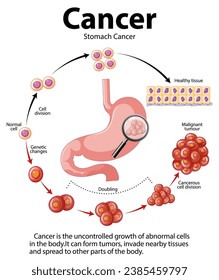 Illustrated infographic depicting abnormal cell growth in stomach cancer