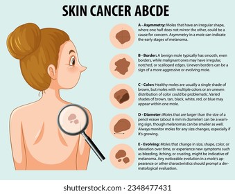 Illustrated infographic depicting abnormal growth of skin cells in skin cancer