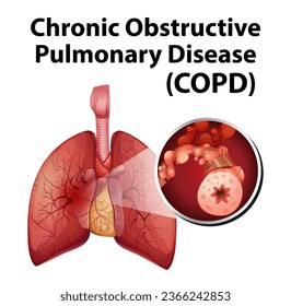 Illustrated infographic explaining chronic obstructive pulmonary disease in human anatomy