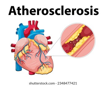 Illustrierte Infografik zur Entwicklung von Herzanatomie und Atherosklerose