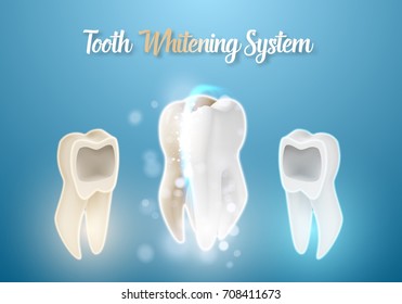 Illustration of 3D Realistic Vector Teeth Cleaning Process. Healthcare Stomatology Procedure