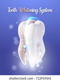 Illustration of 3D Realistic Vector Tooth Cleaning Process. Vector Teeth Cleaning Healthcare Stomatology Procedure