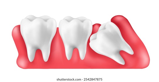 Ilustração vetor 3d realista do dente do siso sob a goma causa da dor e inclinar-se em outros dentes causa da cárie dentária. Conceito de dor na boca, dor de dente, Ovelhas de gradiente de malha usadas