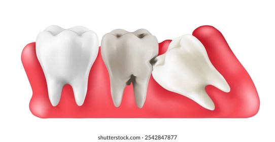 Ilustração vetor 3d realista do dente do siso sob a goma causa da dor e inclinar-se em outros dentes causa da cárie dentária. Conceito de dor na boca, dor de dente, Ovelhas de gradiente de malha usadas