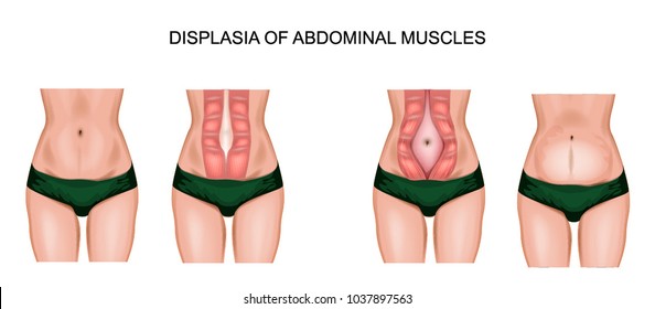 illustration of abdominal muscle diastasis after pregnancy