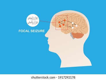 Illustration Of Abnormal Eletrical Activity In Region Of Human Brain Causing Focal Seizure Or Epilepsy. Human Brain And Blue Background.