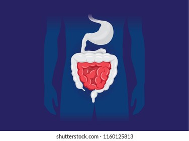 Illustration about abnormal symptom of human small Intestines. Disease about Digestive system.