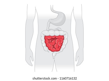 Illustration about abnormal symptom of human small Intestines. Disease about Digestive system.