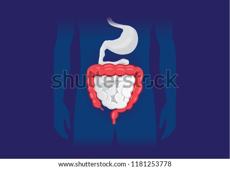 Illustration about abnormal symptom of human large Intestine. Disease about Digestive system.