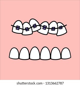 Illustration about dental healthcare with the image of braces on teeth. 
Vector image of the stages of orthodontic treatment for posters for dental clinic. EPS10