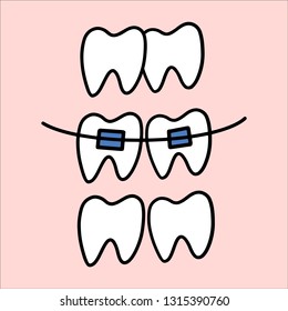 Illustration about dental healthcare with the image of braces on teeth. EPS10. Vector image of the stages of orthodontic treatment for posters for dental clinic.