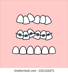 Illustration about dental healthcare with the image of braces on teeth. EPS10. 
Vector image of the stages of orthodontic treatment for posters for dental clinic in flat style on pink background.